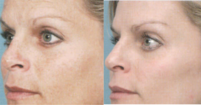 elos foto facial - rejuvenate laser and skin clinic