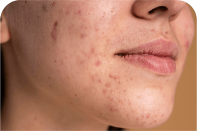 acne treatment rockhampton