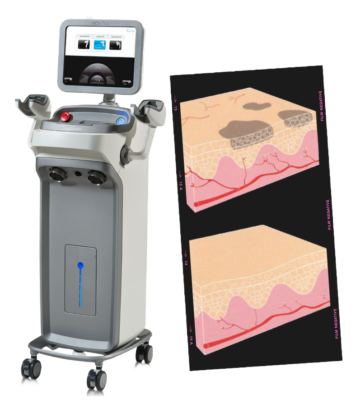 Elos FotoFacial Laser Rejuvenation